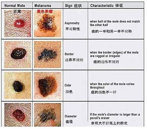 腰上有痣|关于痣你不知道的事儿